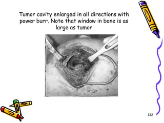 Tumor cavity enlarged in all directions with power burr. Note that window in bone is as large as tumor132