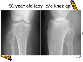 51 year old lady  c/o knee apin15