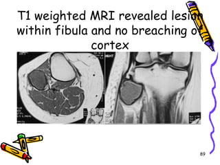 T1 weighted MRI revealed lesion within fibula and no breaching of cortex89