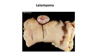 Leiomyoma
 