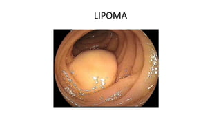 LIPOMA
 