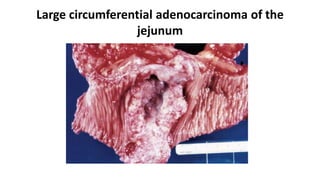 Large circumferential adenocarcinoma of the
jejunum
 