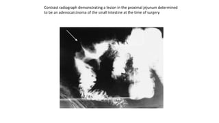 Contrast radiograph demonstrating a lesion in the proximal jejunum determined
to be an adenocarcinoma of the small intestine at the time of surgery
 