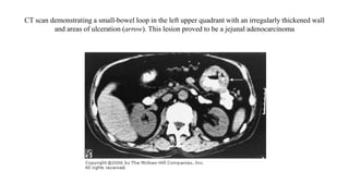 CT scan demonstrating a small-bowel loop in the left upper quadrant with an irregularly thickened wall
and areas of ulceration (arrow). This lesion proved to be a jejunal adenocarcinoma
 