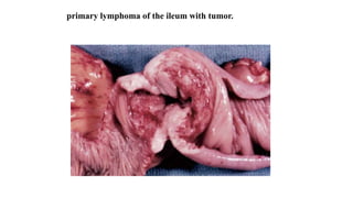 primary lymphoma of the ileum with tumor.
 