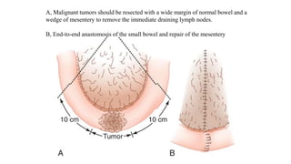 A, Malignant tumors should be resected with a wide margin of normal bowel and a
wedge of mesentery to remove the immediate draining lymph nodes.
B, End-to-end anastomosis of the small bowel and repair of the mesentery
 