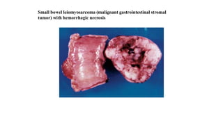 Small bowel leiomyosarcoma (malignant gastrointestinal stromal
tumor) with hemorrhagic necrosis
 