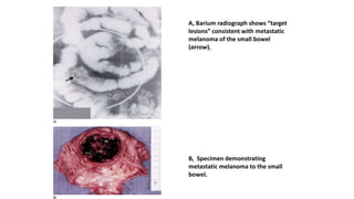 A, Barium radiograph shows “target
lesions” consistent with metastatic
melanoma of the small bowel
(arrow).
B, Specimen demonstrating
metastatic melanoma to the small
bowel.
 