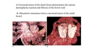 A-Carcinoid tumor of the distal ileum demonstrates the intense
desmoplastic reaction and fibrosis of the bowel wall.
B -Mesenteric metastases from a carcinoid tumor of the small
bowel.
 