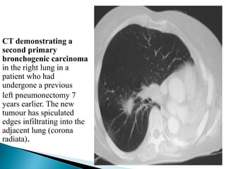 TUMORS & METASTASIS chest diaease for physiotherapy.pptx