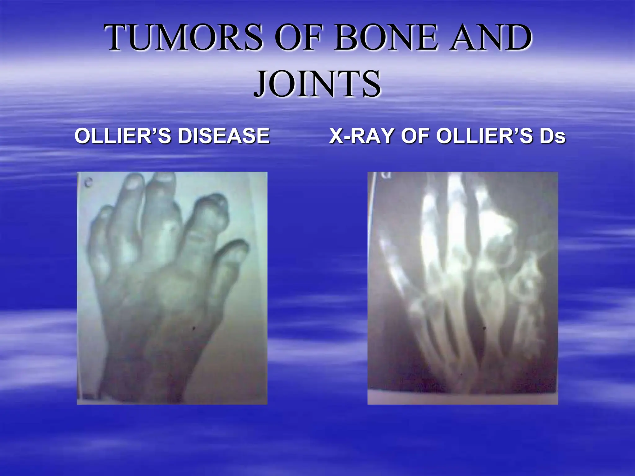 TUMORS OF BONE AND JOINTS IN ORTHOPAEDICS (4).ppt