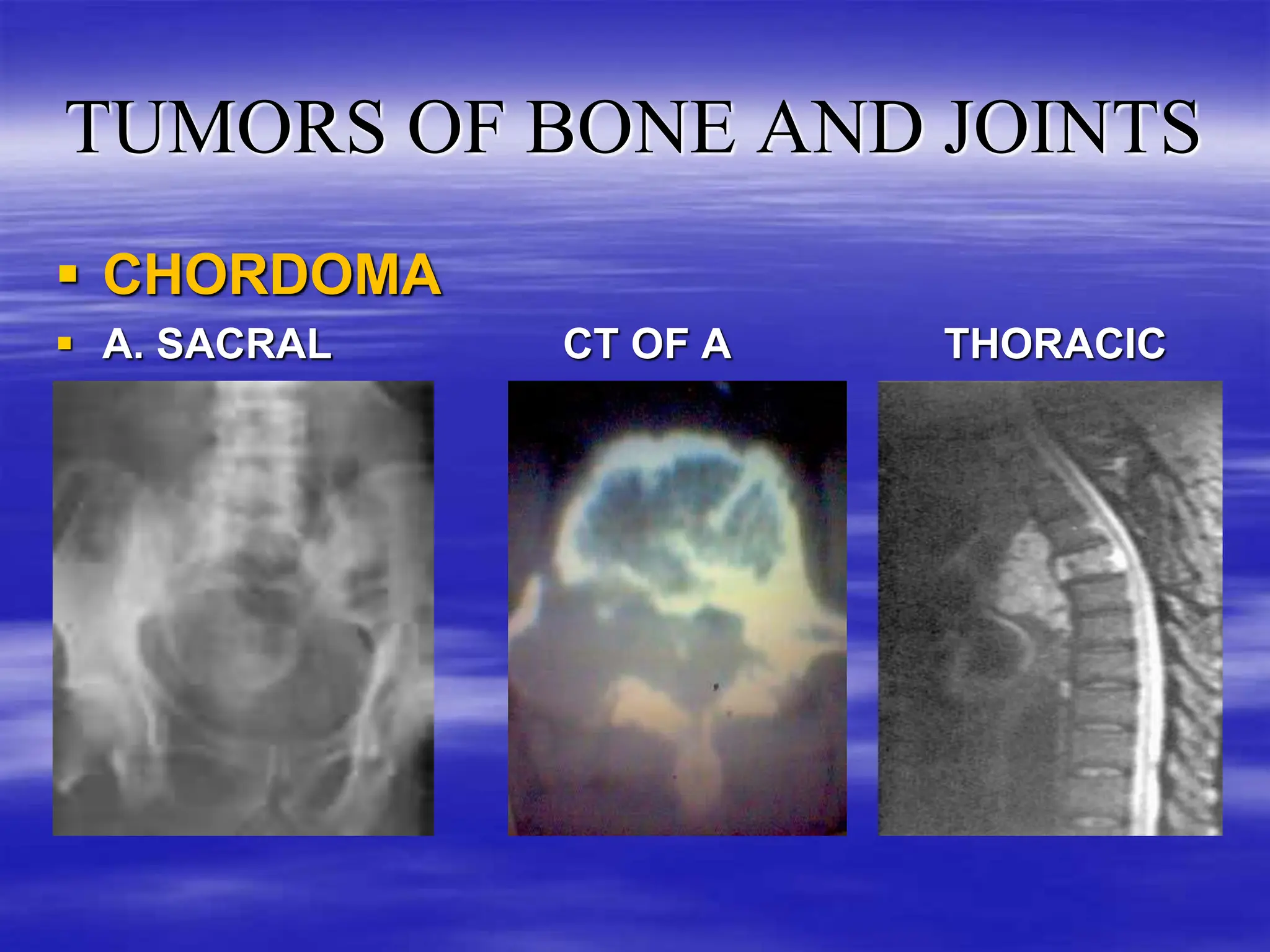 TUMORS OF BONE AND JOINTS IN ORTHOPAEDICS (4).ppt