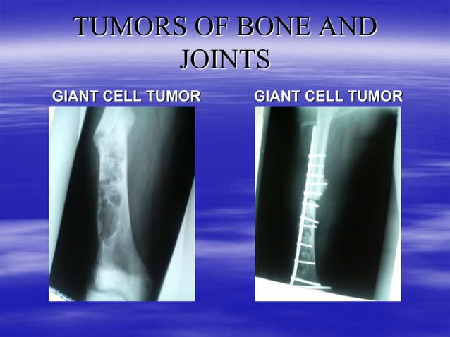 TUMORS OF BONE AND JOINTS IN ORTHOPAEDICS (4).ppt
