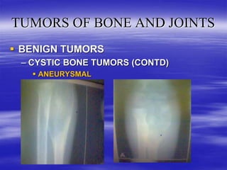 TUMORS OF BONE AND JOINTS IN ORTHOPAEDICS (4).ppt