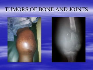 TUMORS OF BONE AND JOINTS IN ORTHOPAEDICS (4).ppt