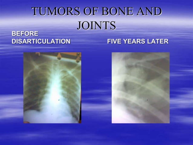 TUMORS OF BONE AND JOINTS IN ORTHOPAEDICS (4).ppt