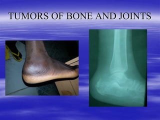 TUMORS OF BONE AND JOINTS IN ORTHOPAEDICS (4).ppt