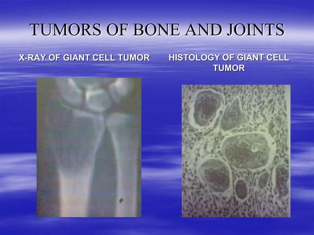 TUMORS OF BONE AND JOINTS IN ORTHOPAEDICS (4).ppt