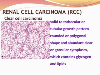 Tumors of kidney & urinary tract 2012 | PPT