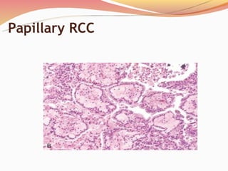 Papillary Rcc Radiopaedia Tumors of kidney & urinary tract 2012 | PPT