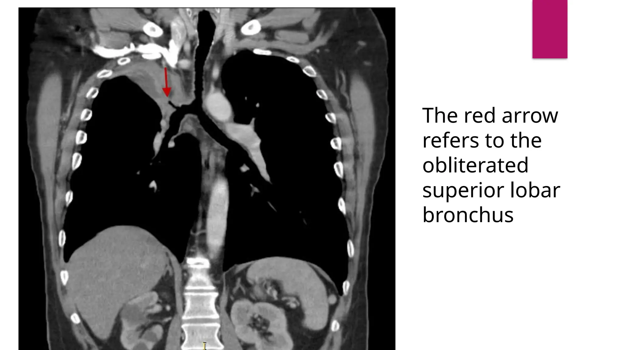 The red arrow
refers to the
obliterated
superior lobar
bronchus
 