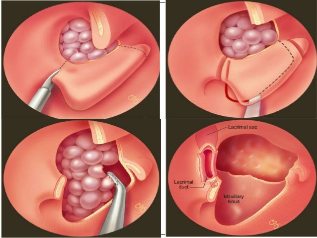 Maxillary sinus cancer