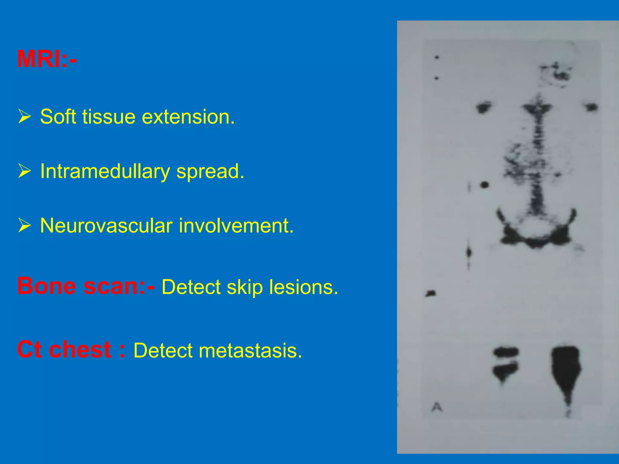 MRI:-
 Soft tissue extension.
 Intramedullary spread.
 Neurovascular involvement.
Bone scan:- Detect skip lesions.
Ct chest : Detect metastasis.
 