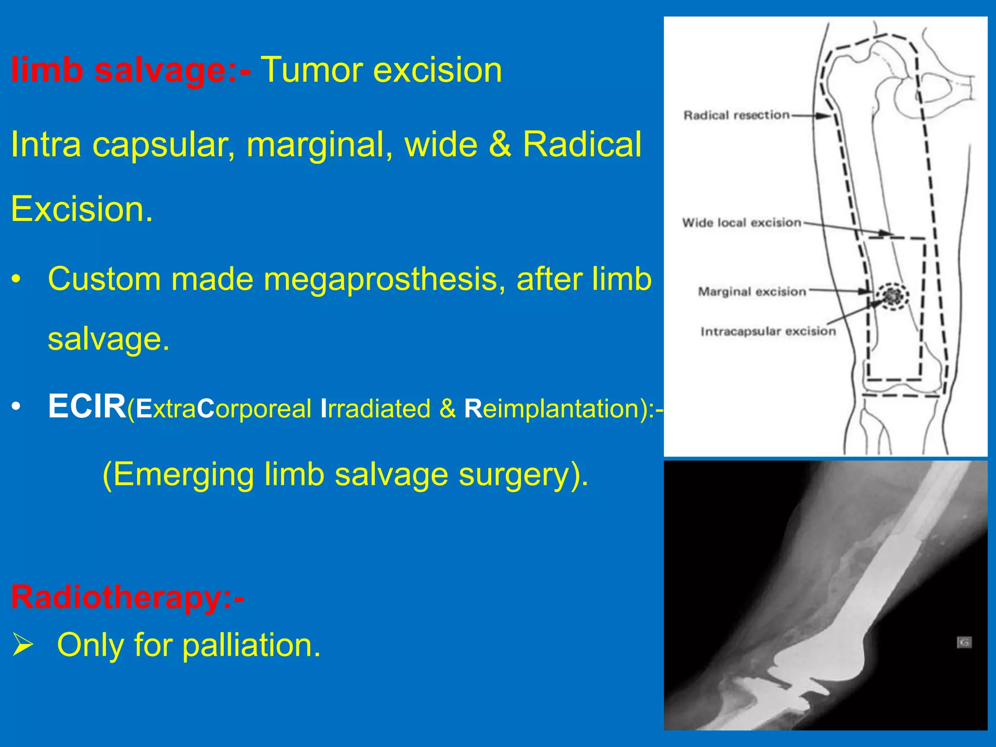 limb salvage:- Tumor excision
Intra capsular, marginal, wide & Radical
Excision.
• Custom made megaprosthesis, after limb
salvage.
• ECIR(ExtraCorporeal Irradiated & Reimplantation):-
(Emerging limb salvage surgery).
Radiotherapy:-
 Only for palliation.
 