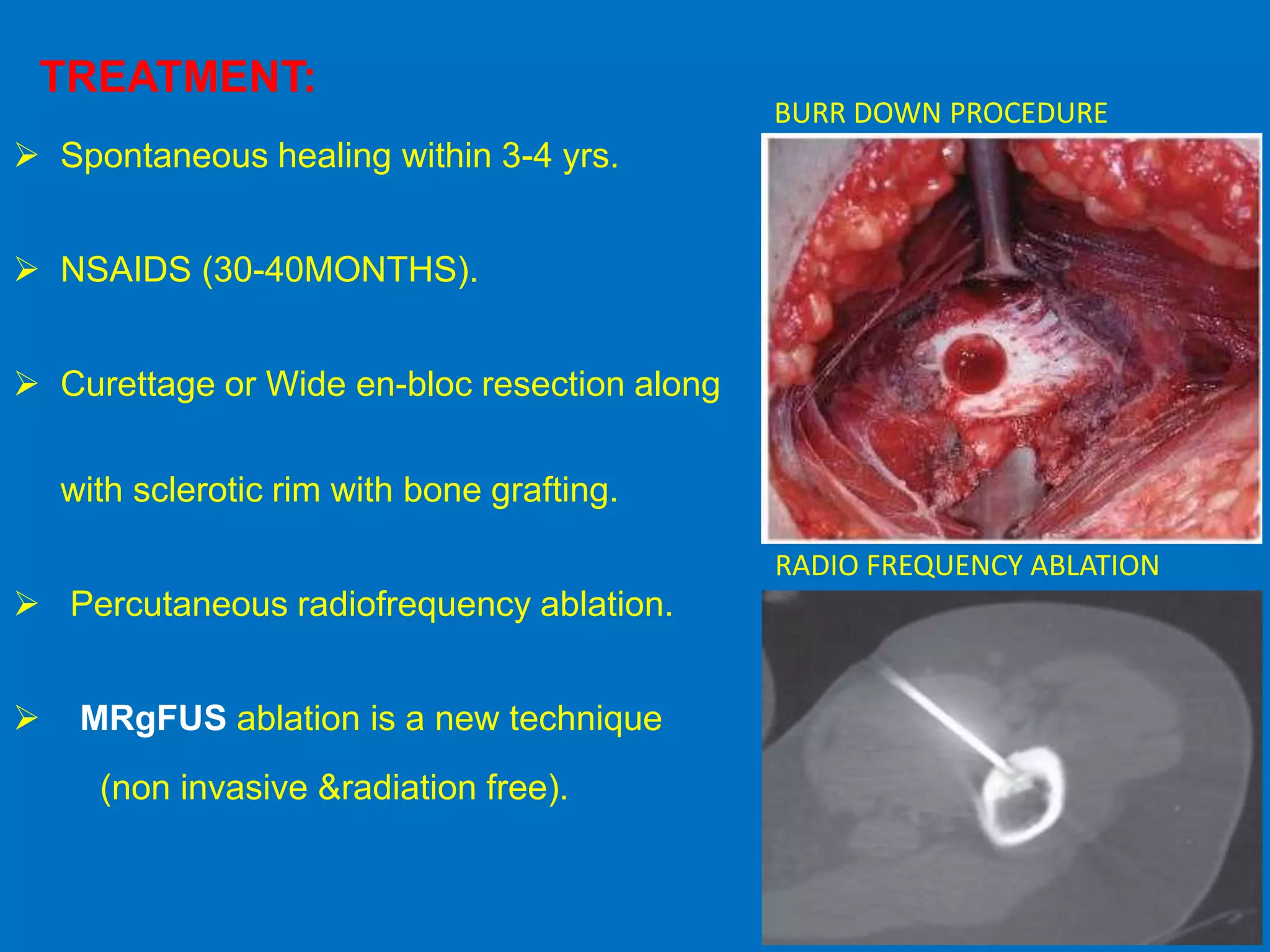 TREATMENT:
 Spontaneous healing within 3-4 yrs.
 NSAIDS (30-40MONTHS).
 Curettage or Wide en-bloc resection along
with sclerotic rim with bone grafting.
 Percutaneous radiofrequency ablation.
 MRgFUS ablation is a new technique
(non invasive &radiation free).
BURR DOWN PROCEDURE
RADIO FREQUENCY ABLATION
 