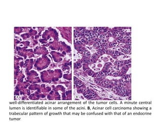 Tumors of pancreas | PPTX