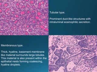 Tumors of salivary gland | PPT