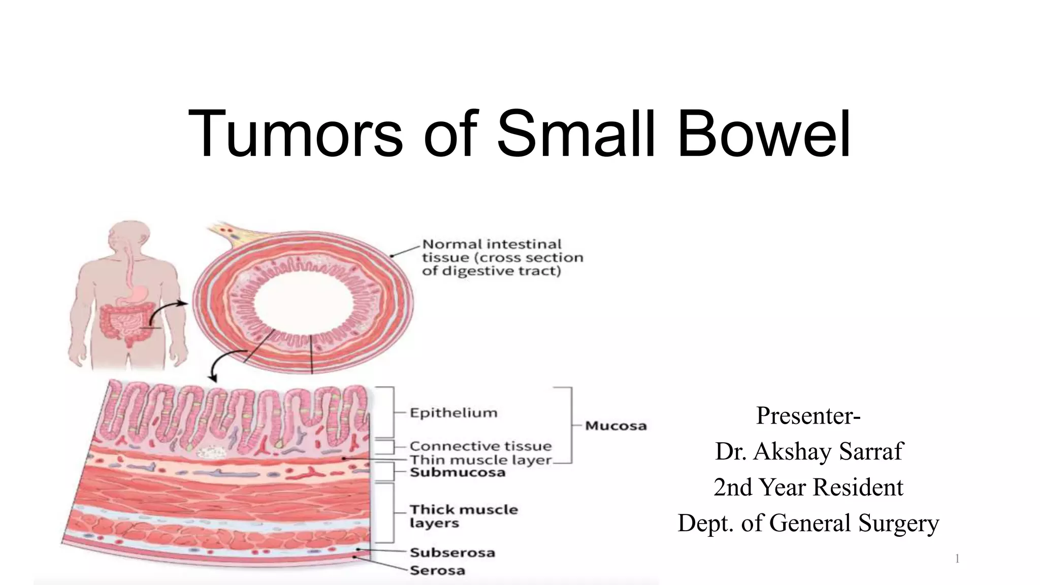Tumors of small bowel.pptx
