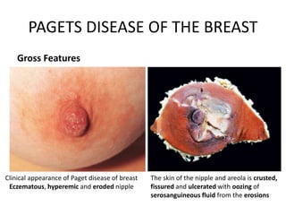 Tumors Of The Breast