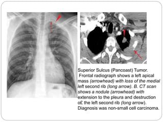 Radiology of lung neoplasms | PPTX