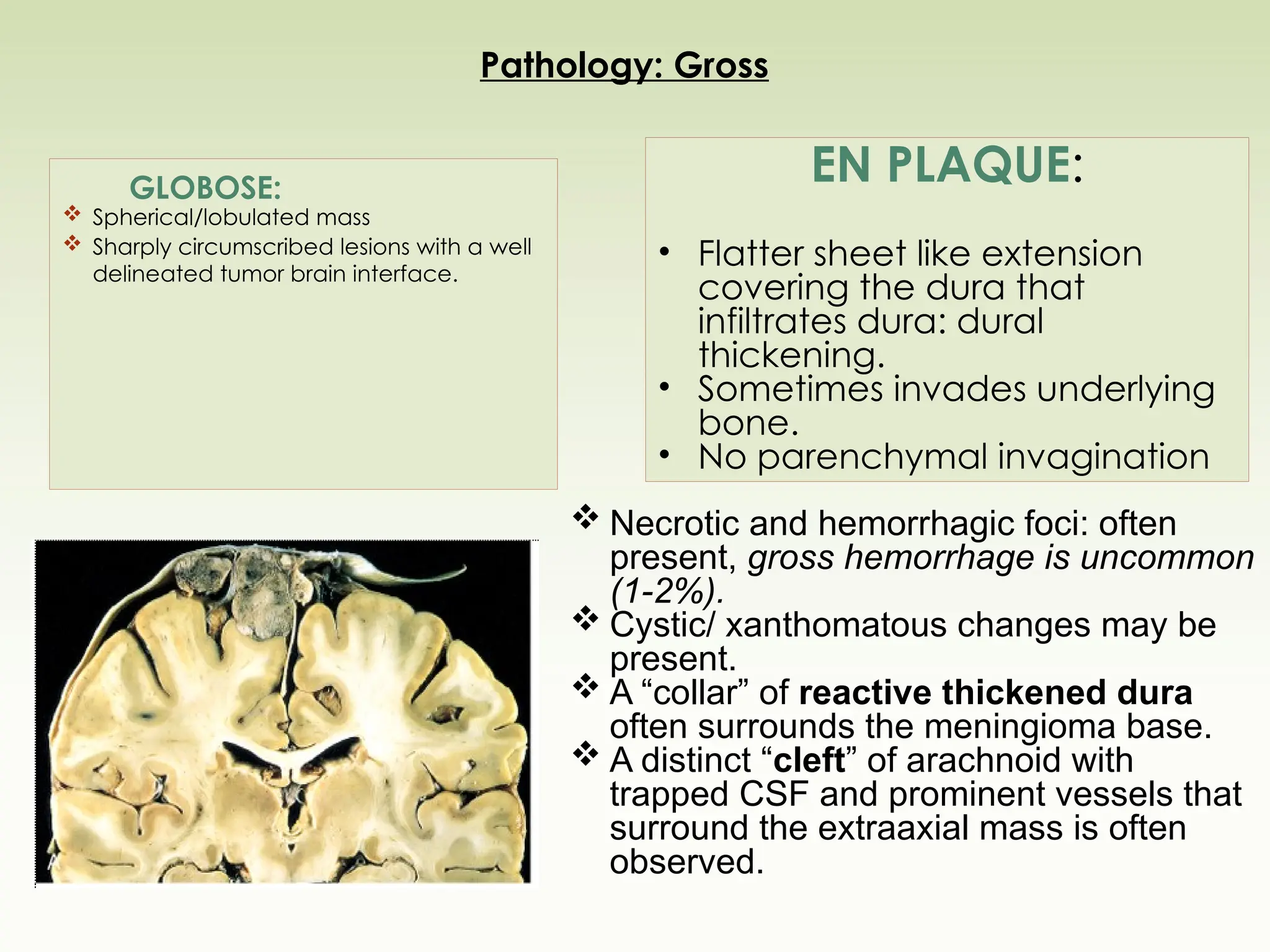 Pathology: Gross
GLOBOSE:
 Spherical/lobulated mass
 Sharply circumscribed lesions with a well
delineated tumor brain interface.
EN PLAQUE:
• Flatter sheet like extension
covering the dura that
infiltrates dura: dural
thickening.
• Sometimes invades underlying
bone.
• No parenchymal invagination
 Necrotic and hemorrhagic foci: often
present, gross hemorrhage is uncommon
(1-2%).
 Cystic/ xanthomatous changes may be
present.
 A “collar” of reactive thickened dura
often surrounds the meningioma base.
 A distinct “cleft” of arachnoid with
trapped CSF and prominent vessels that
surround the extraaxial mass is often
observed.
 