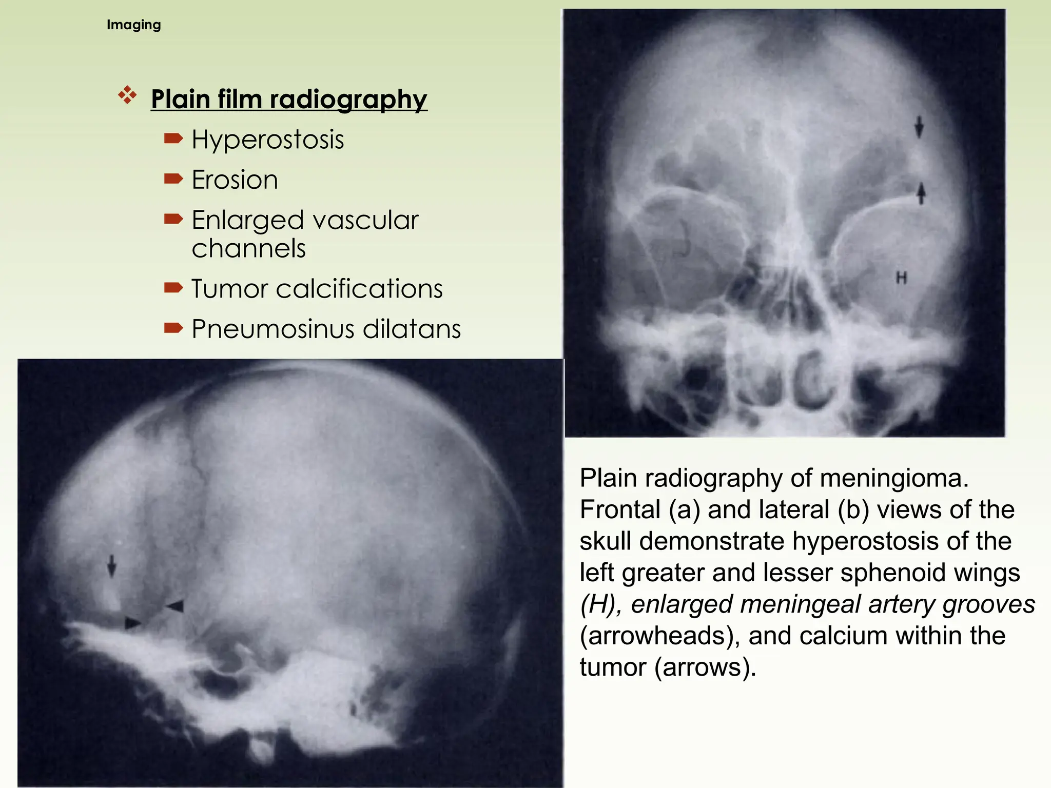Imaging
 Plain film radiography
 Hyperostosis
 Erosion
 Enlarged vascular
channels
 Tumor calcifications
 Pneumosinus dilatans
Plain radiography of meningioma.
Frontal (a) and lateral (b) views of the
skull demonstrate hyperostosis of the
left greater and lesser sphenoid wings
(H), enlarged meningeal artery grooves
(arrowheads), and calcium within the
tumor (arrows).
 