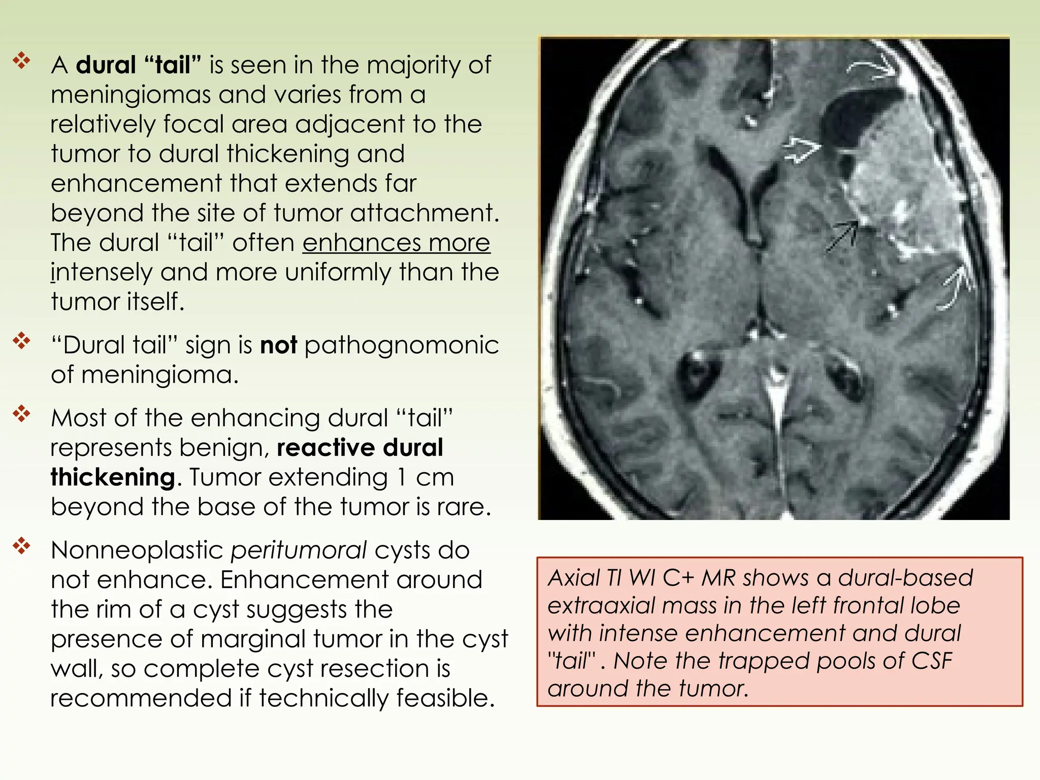  A dural “tail” is seen in the majority of
meningiomas and varies from a
relatively focal area adjacent to the
tumor to dural thickening and
enhancement that extends far
beyond the site of tumor attachment.
The dural “tail” often enhances more
intensely and more uniformly than the
tumor itself.
 “Dural tail” sign is not pathognomonic
of meningioma.
 Most of the enhancing dural “tail”
represents benign, reactive dural
thickening. Tumor extending 1 cm
beyond the base of the tumor is rare.
 Nonneoplastic peritumoral cysts do
not enhance. Enhancement around
the rim of a cyst suggests the
presence of marginal tumor in the cyst
wall, so complete cyst resection is
recommended if technically feasible.
Axial TI WI C+ MR shows a dural-based
extraaxial mass in the left frontal lobe
with intense enhancement and dural
"tail" . Note the trapped pools of CSF
around the tumor.
 