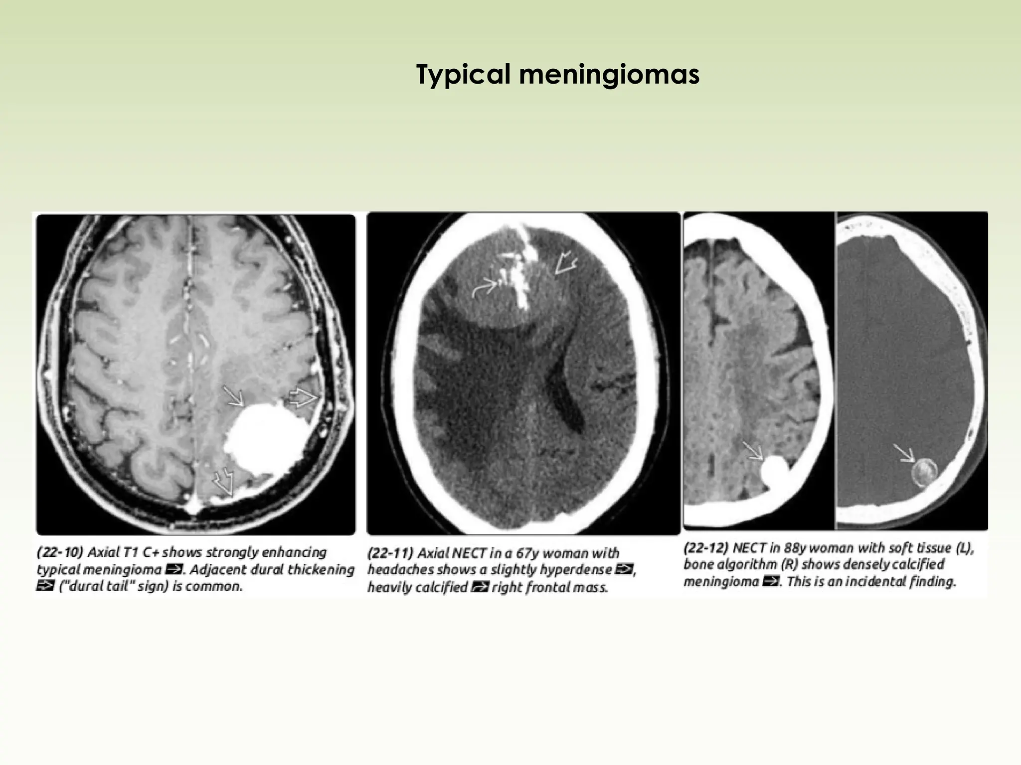 Typical meningiomas
 