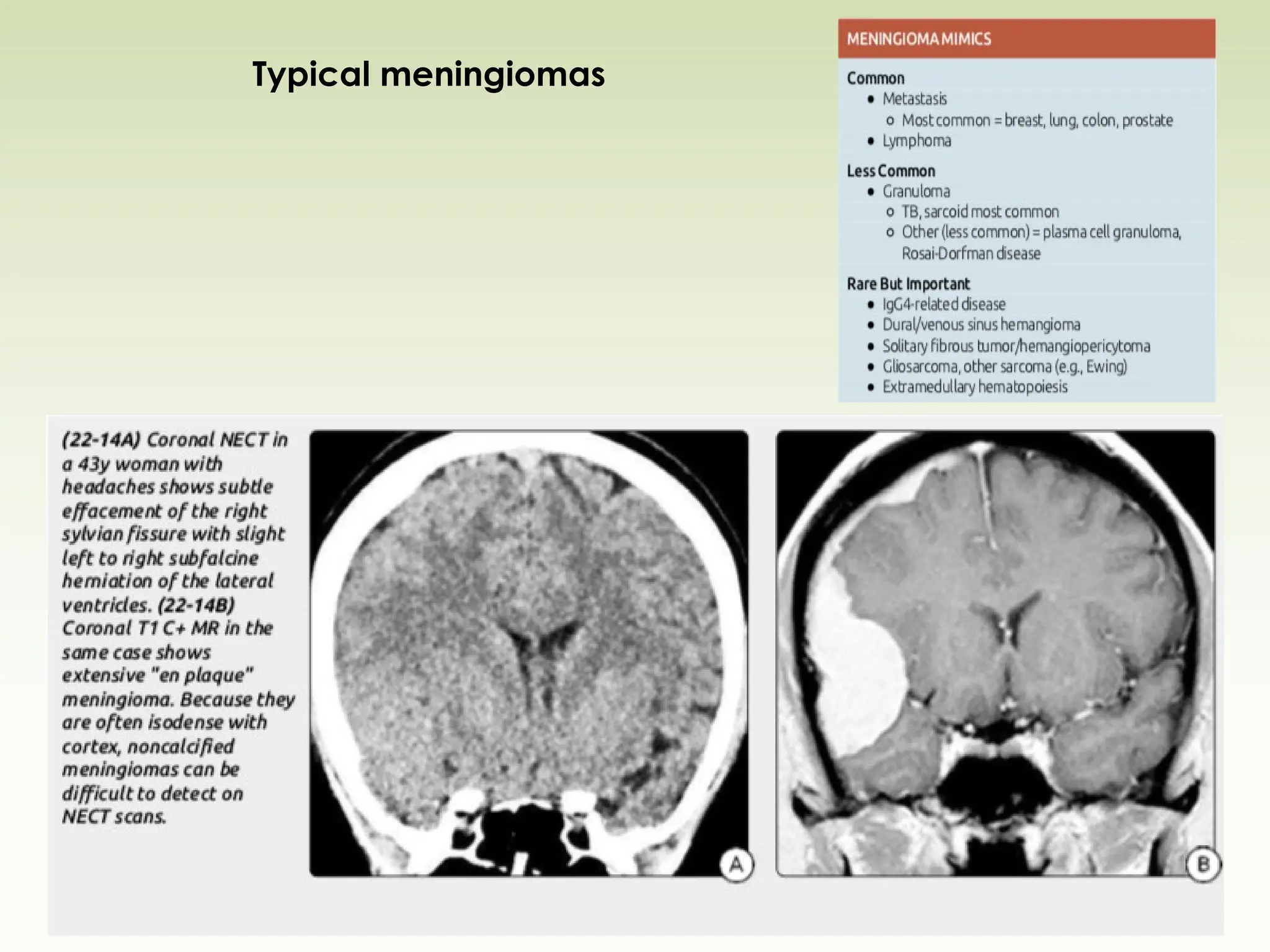 Typical meningiomas
 