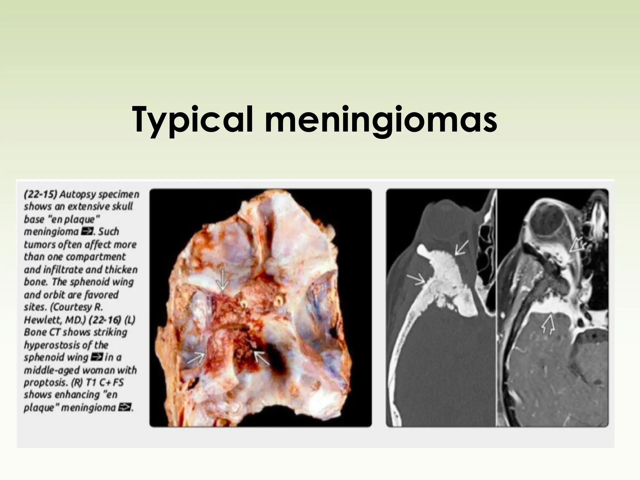 Typical meningiomas
 