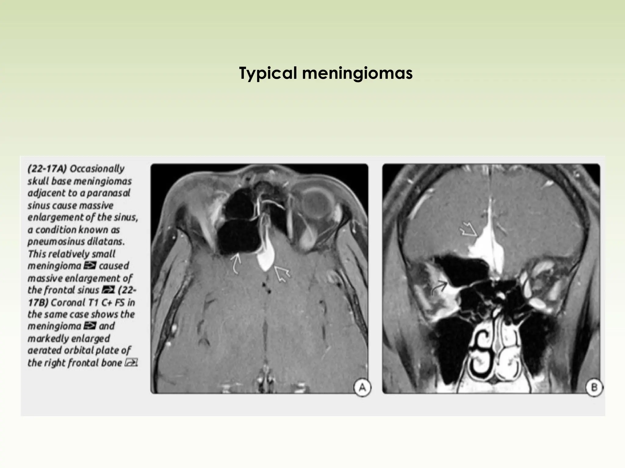 Typical meningiomas
 