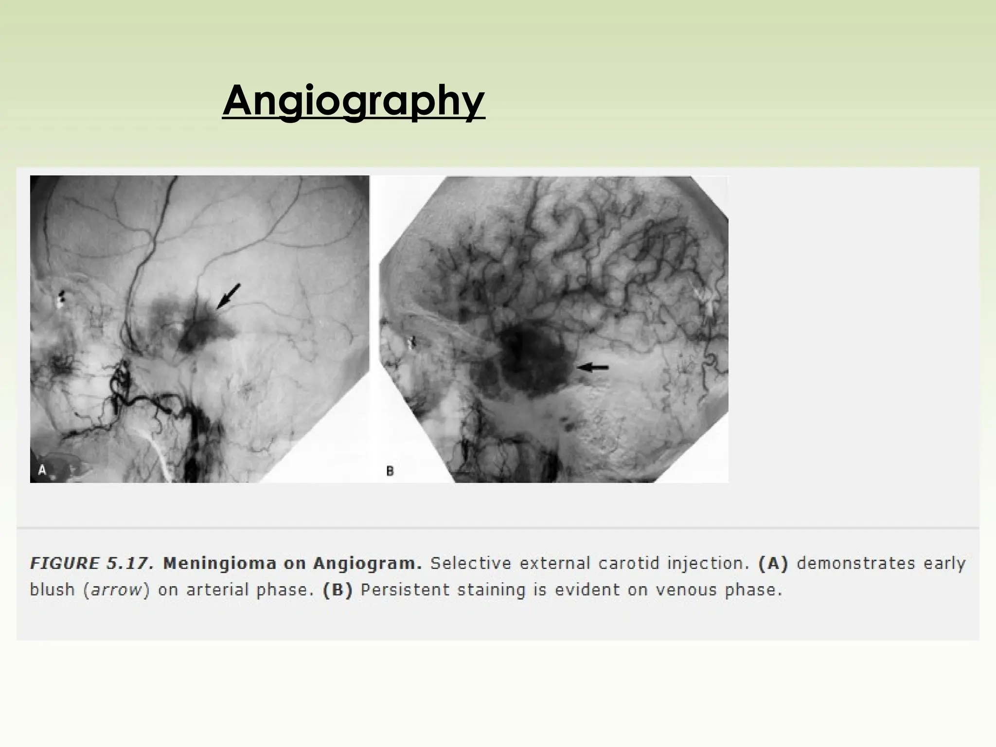 Angiography
 