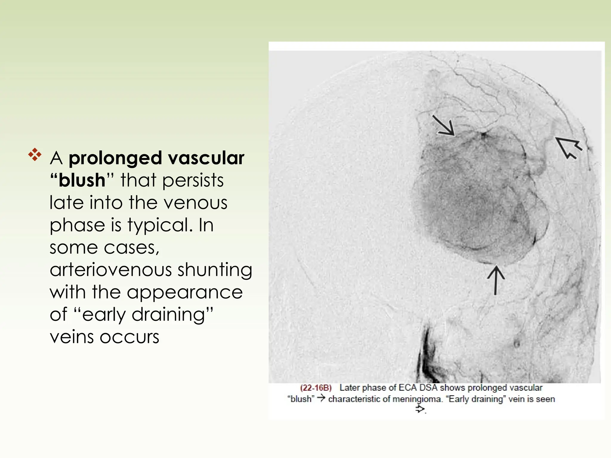  A prolonged vascular
“blush” that persists
late into the venous
phase is typical. In
some cases,
arteriovenous shunting
with the appearance
of “early draining”
veins occurs
 