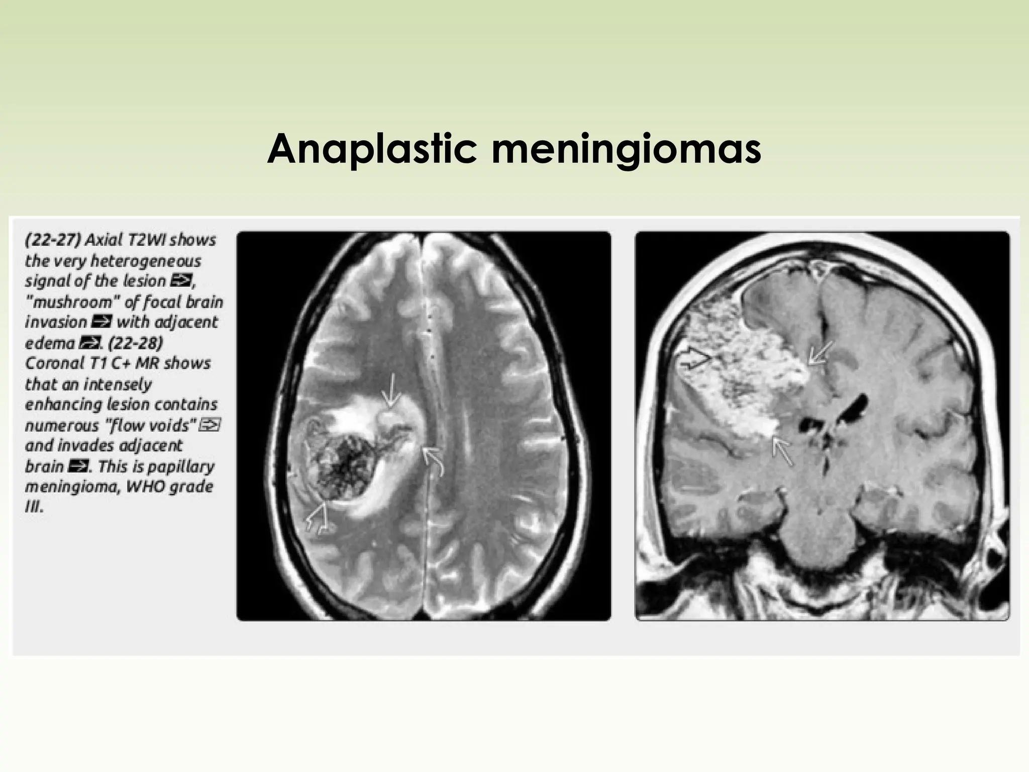 Anaplastic meningiomas
 