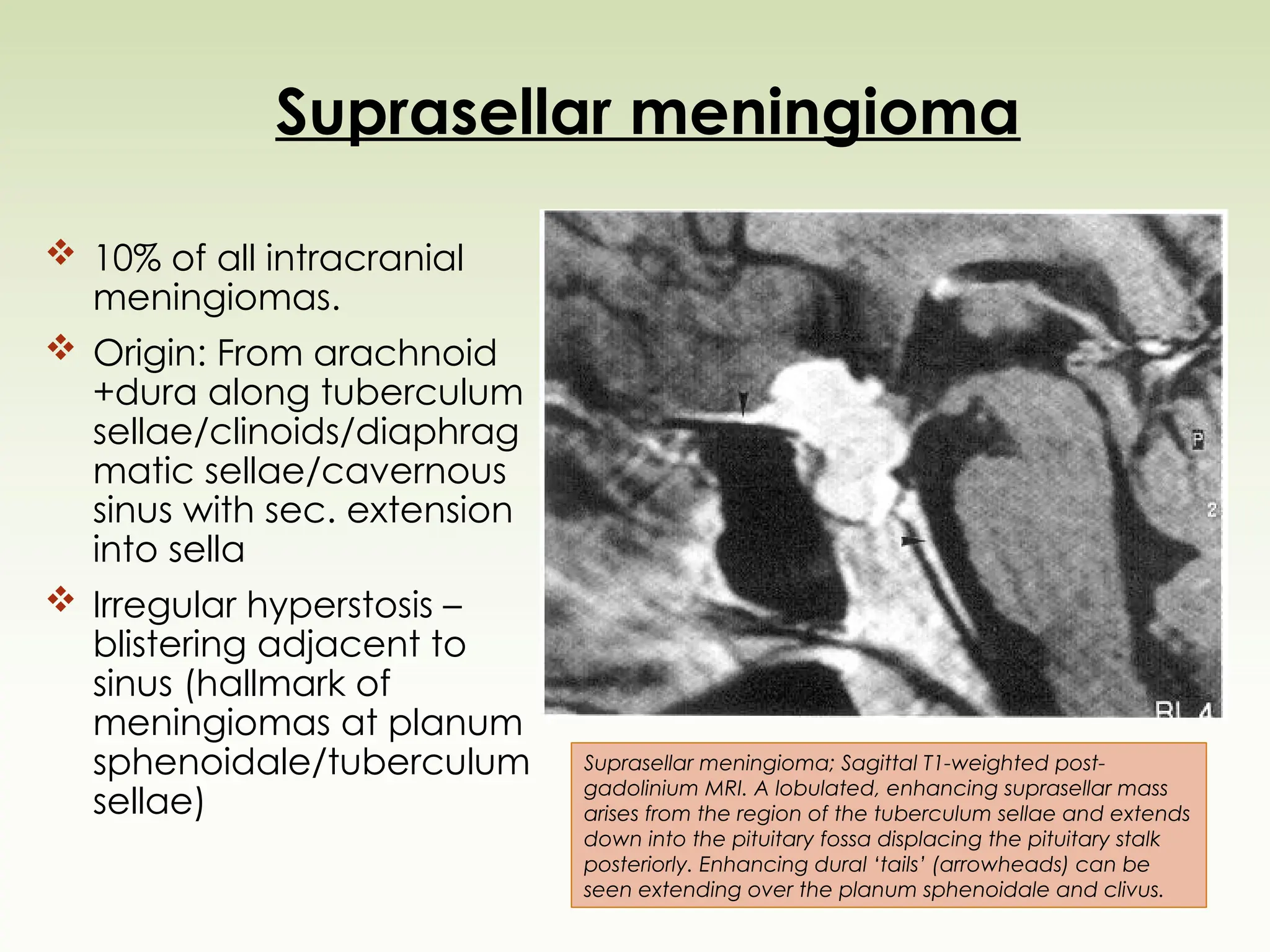 Suprasellar meningioma
 10% of all intracranial
meningiomas.
 Origin: From arachnoid
+dura along tuberculum
sellae/clinoids/diaphrag
matic sellae/cavernous
sinus with sec. extension
into sella
 Irregular hyperstosis –
blistering adjacent to
sinus (hallmark of
meningiomas at planum
sphenoidale/tuberculum
sellae)
Suprasellar meningioma; Sagittal T1-weighted post-
gadolinium MRI. A lobulated, enhancing suprasellar mass
arises from the region of the tuberculum sellae and extends
down into the pituitary fossa displacing the pituitary stalk
posteriorly. Enhancing dural ‘tails’ (arrowheads) can be
seen extending over the planum sphenoidale and clivus.
 
