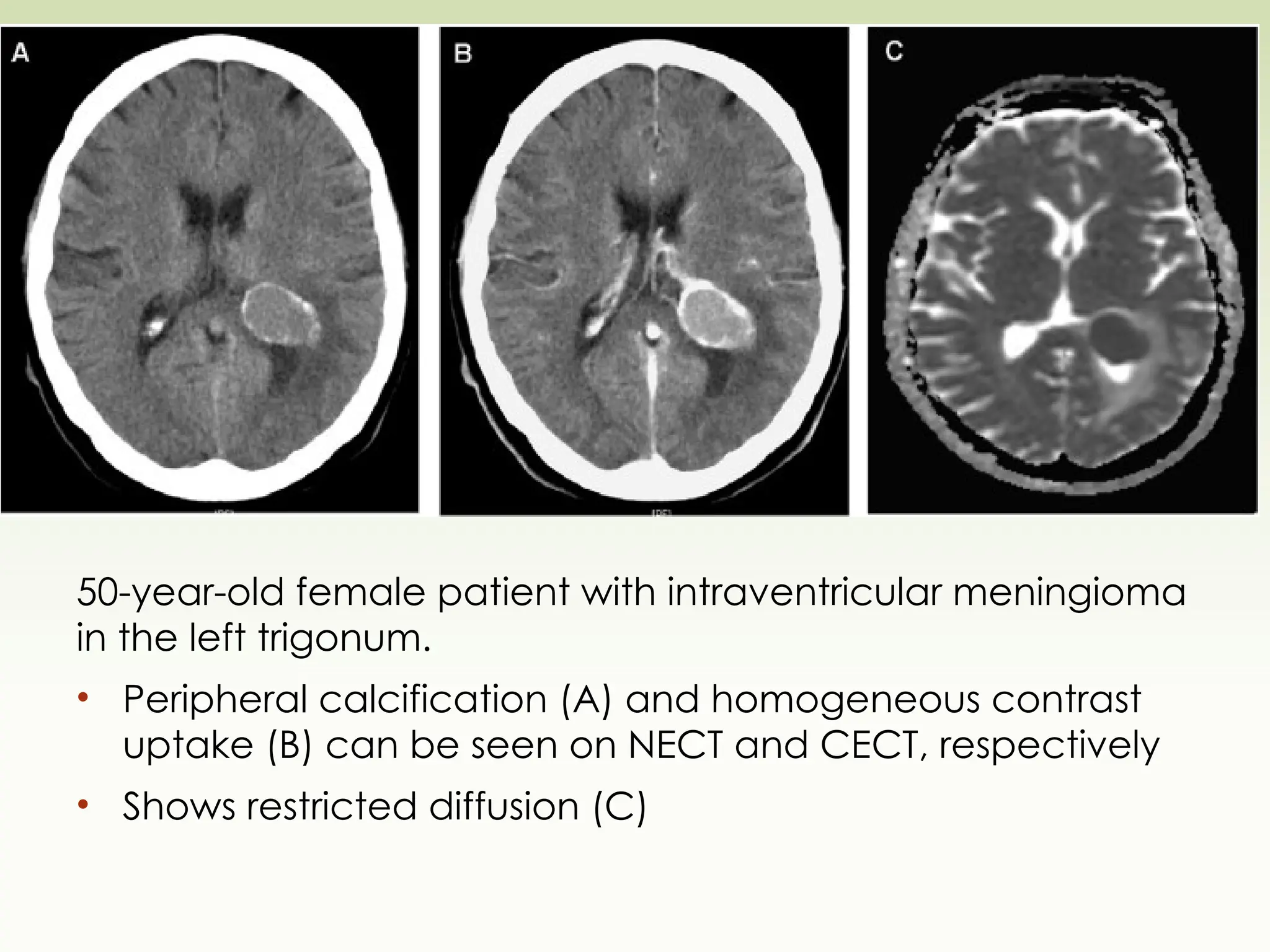 50-year-old female patient with intraventricular meningioma
in the left trigonum.
• Peripheral calcification (A) and homogeneous contrast
uptake (B) can be seen on NECT and CECT, respectively
• Shows restricted diffusion (C)
 
