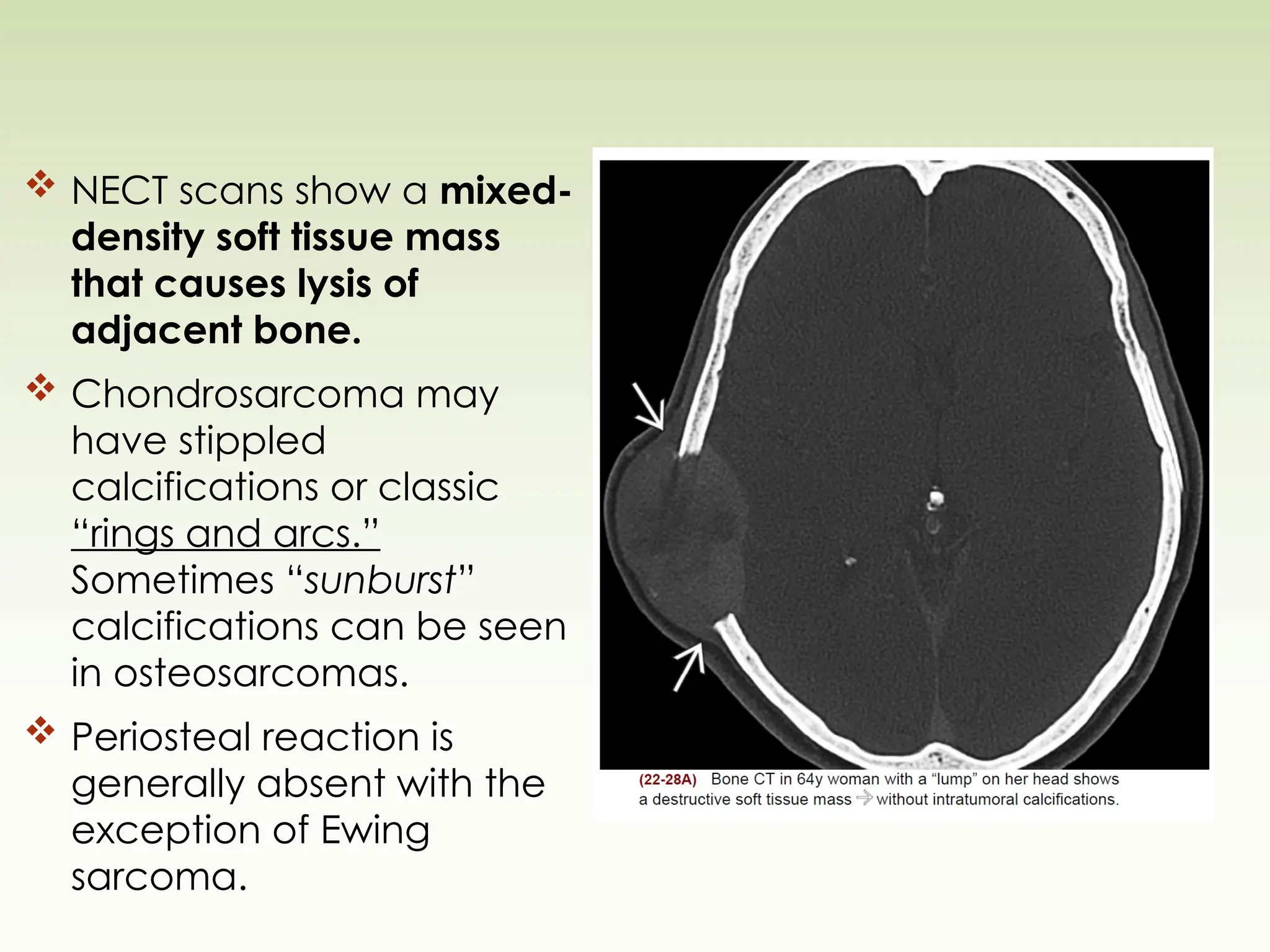  NECT scans show a mixed-
density soft tissue mass
that causes lysis of
adjacent bone.
 Chondrosarcoma may
have stippled
calcifications or classic
“rings and arcs.”
Sometimes “sunburst”
calcifications can be seen
in osteosarcomas.
 Periosteal reaction is
generally absent with the
exception of Ewing
sarcoma.
 