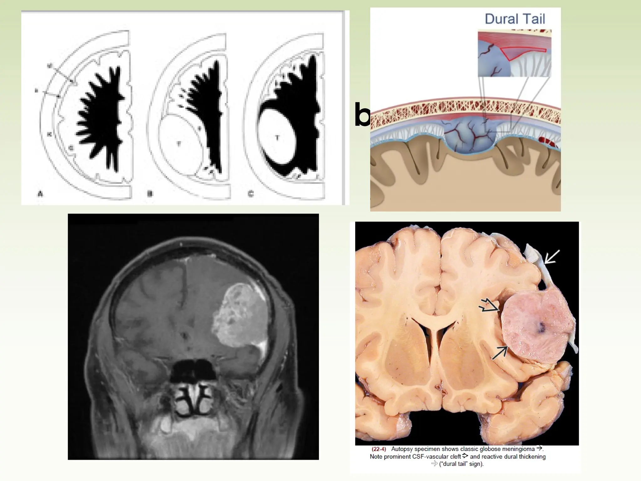 White matter buckling
 