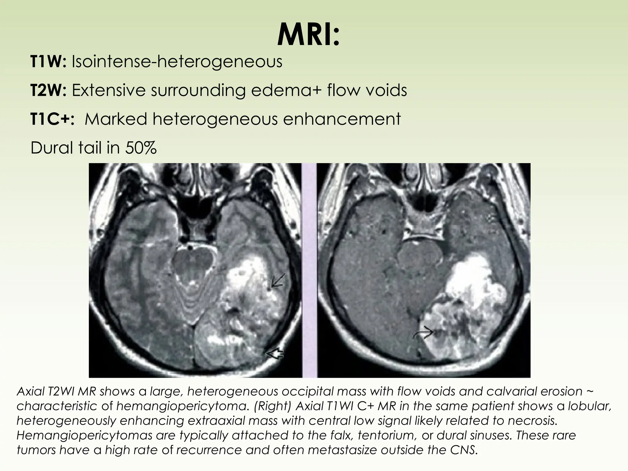 MRI:
T1W: Isointense-heterogeneous
T2W: Extensive surrounding edema+ flow voids
T1C+: Marked heterogeneous enhancement
Dural tail in 50%
Axial T2WI MR shows a large, heterogeneous occipital mass with flow voids and calvarial erosion ~
characteristic of hemangiopericytoma. (Right) Axial T1WI C+ MR in the same patient shows a lobular,
heterogeneously enhancing extraaxial mass with central low signal likely related to necrosis.
Hemangiopericytomas are typically attached to the falx, tentorium, or dural sinuses. These rare
tumors have a high rate of recurrence and often metastasize outside the CNS.
 