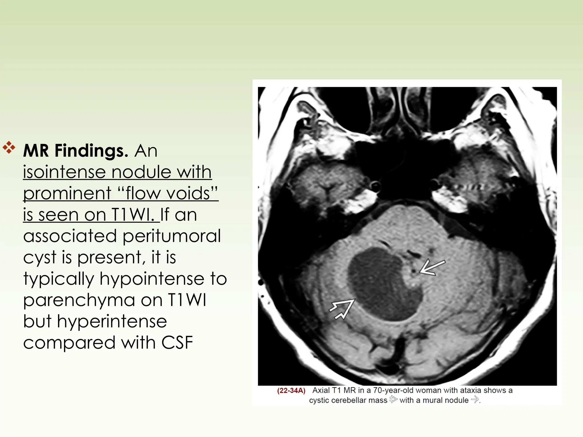  MR Findings. An
isointense nodule with
prominent “flow voids”
is seen on T1WI. If an
associated peritumoral
cyst is present, it is
typically hypointense to
parenchyma on T1WI
but hyperintense
compared with CSF
 